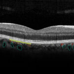 Choroidal layers OCT marked